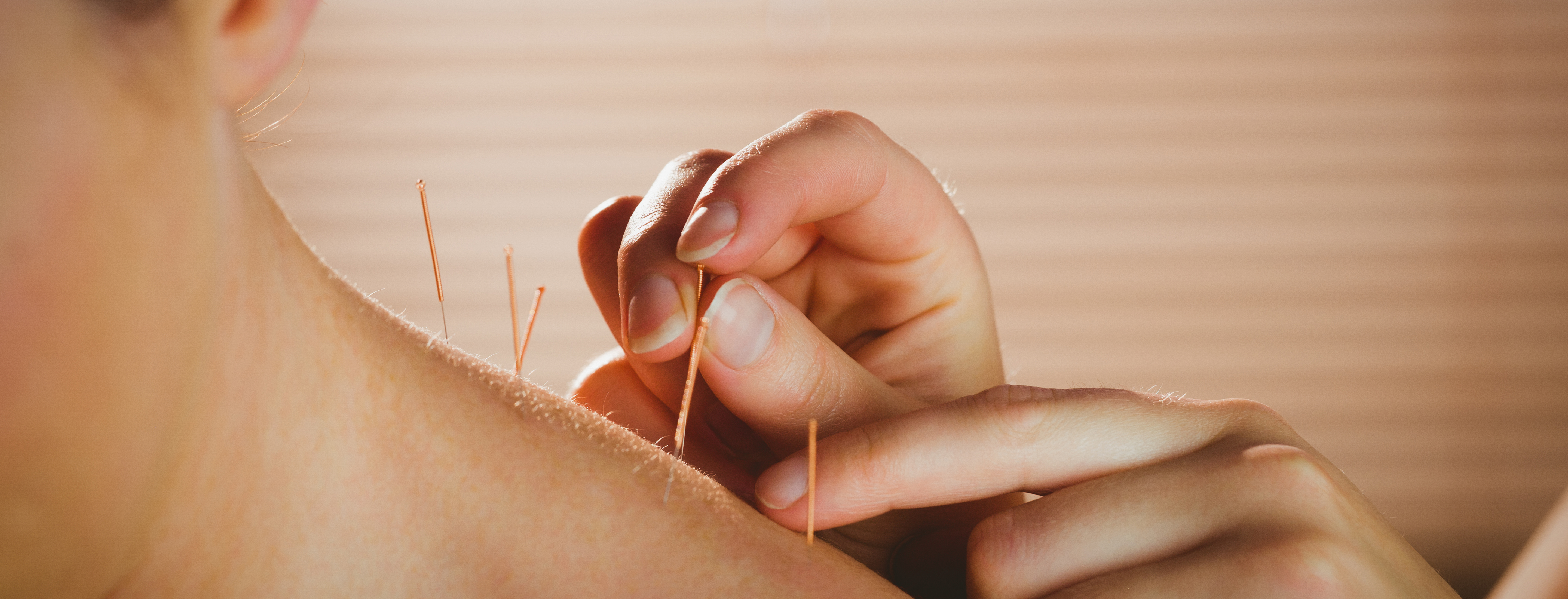 Acupuncture treatment